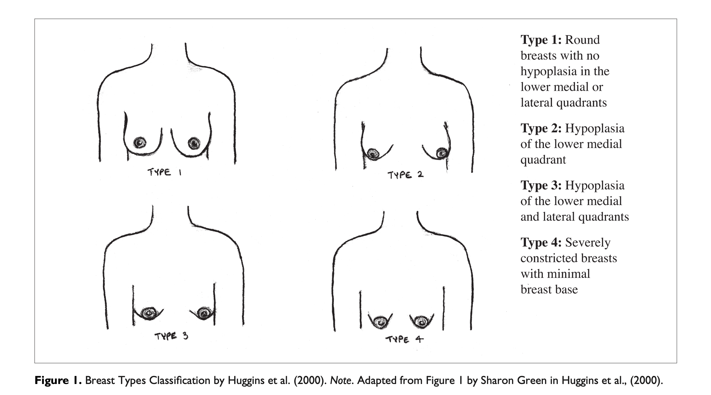 Figure 1: Breast types classification by Huggins et al. (2000)